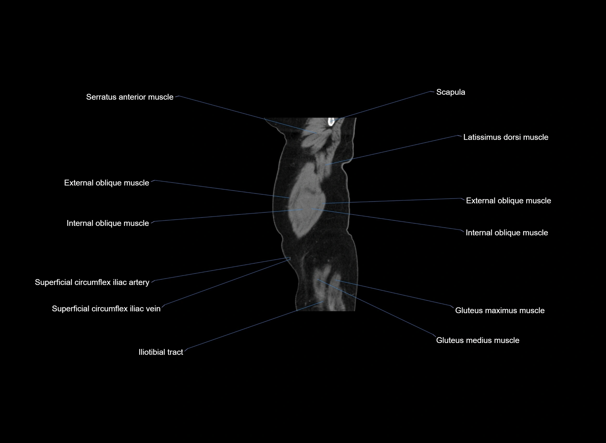 CT Abdomen sagittal cross sectional anatomy labelled radiology image -00107.webp